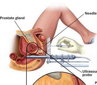 leftus-guided-prostate-biopsy-and-right-prostate-brachytherapycredit-mayo